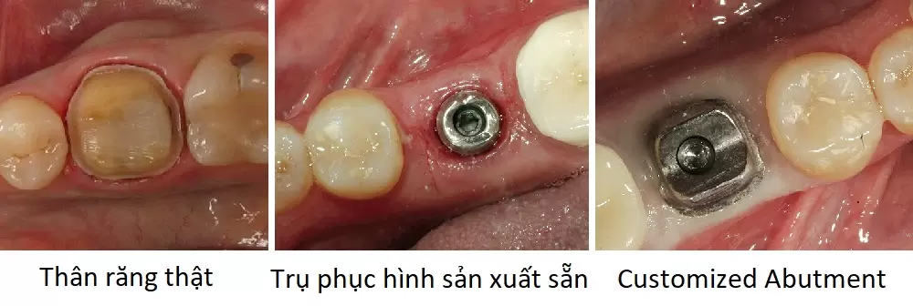 Trụ phục hình giải phẫu cá nhân hóa (Customized Abutment) có cấu trúc đường viền uốn lượn theo bờ lợi của từng răng