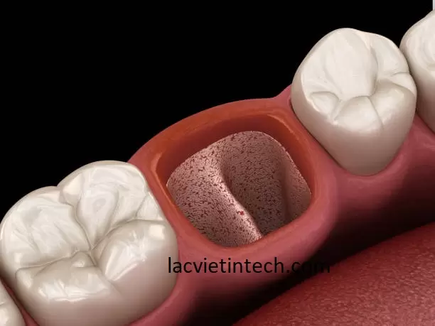 Hình ảnh lỗ lợi lý tưởng của răng hàm (trên răng thật sẽ do thân răng tạo hình).