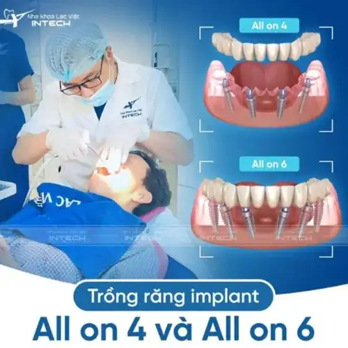 Nha khoa Lạc Việt Intech - Trung tâm trồng răng Implant chuyên sâu - trồng răng implant toàn hàm