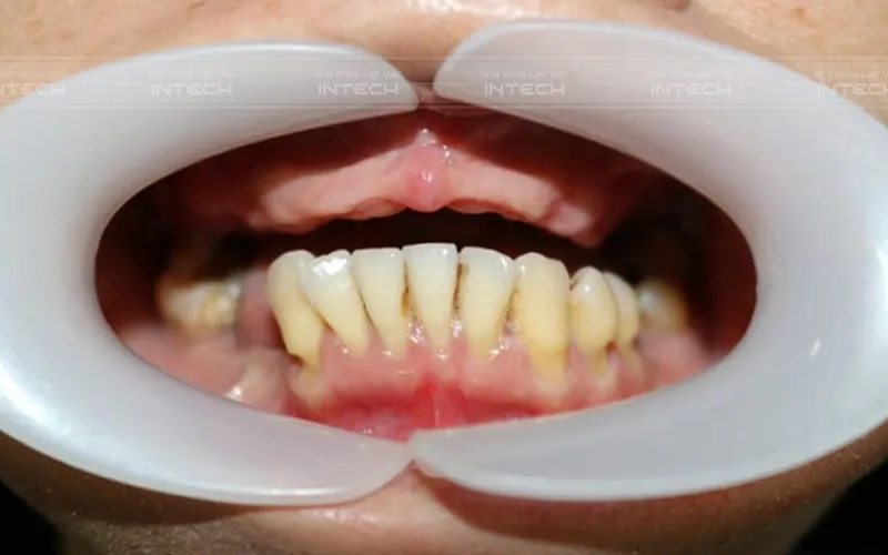 Giá Trồng Răng Cho Người Già - Nha khoa Lạc Việt Intech