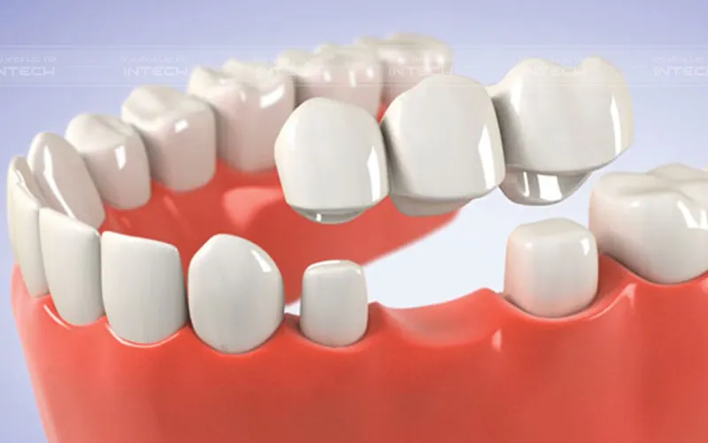 Giá Trồng Răng Cho Người Già - Nha khoa Lạc Việt Intech