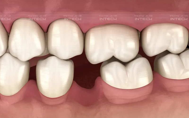 Giá Trồng Răng Cho Người Già - Nha khoa Lạc Việt Intech
