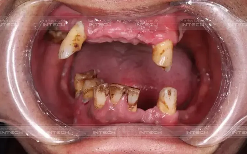 Giá Trồng Răng Cho Người Già - Nha khoa Lạc Việt Intech