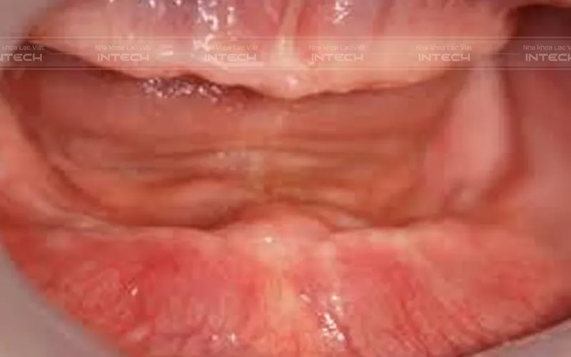 Giá Trồng Răng Cho Người Già - Nha khoa Lạc Việt Intech